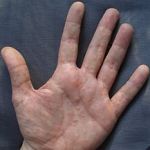 Dyshidrosis. Credits: CC-BY-SA 3.0 Inwe on Wikipedia.de Quelle: http://de.wikipedia.org/wiki/Datei:Dyshidrosis.JPG